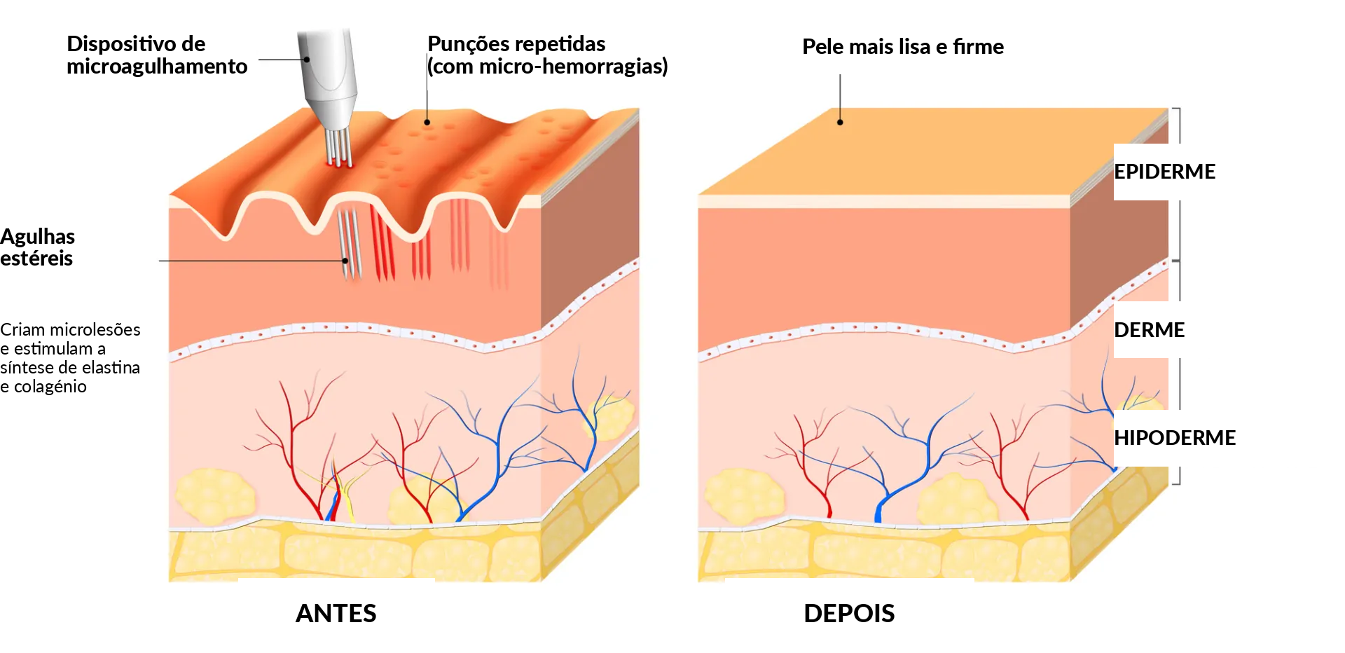 Como funciona o microneedling