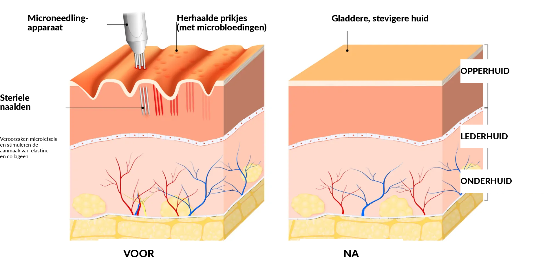 Hoe microneedling werkt