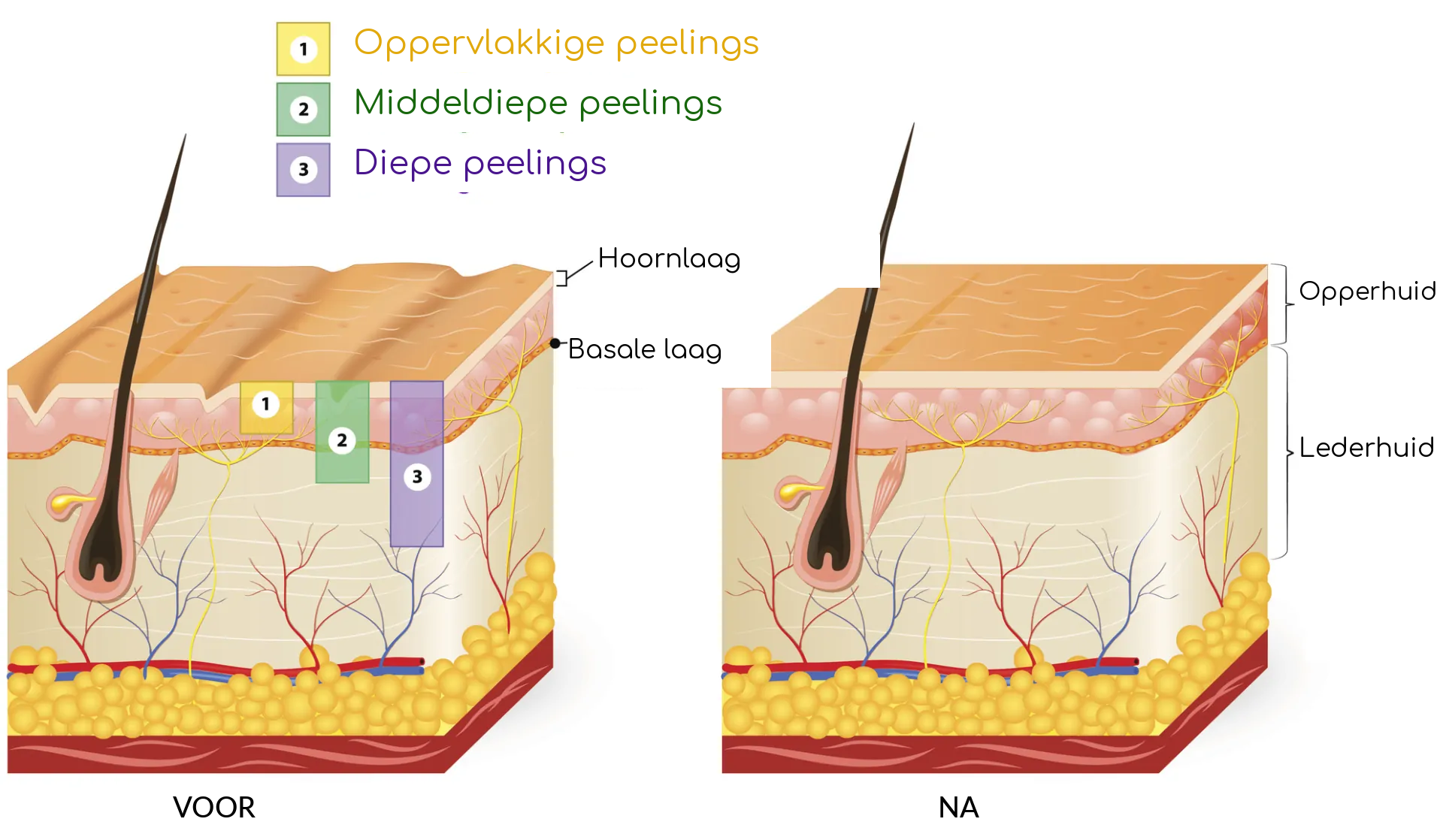Soorten peelings