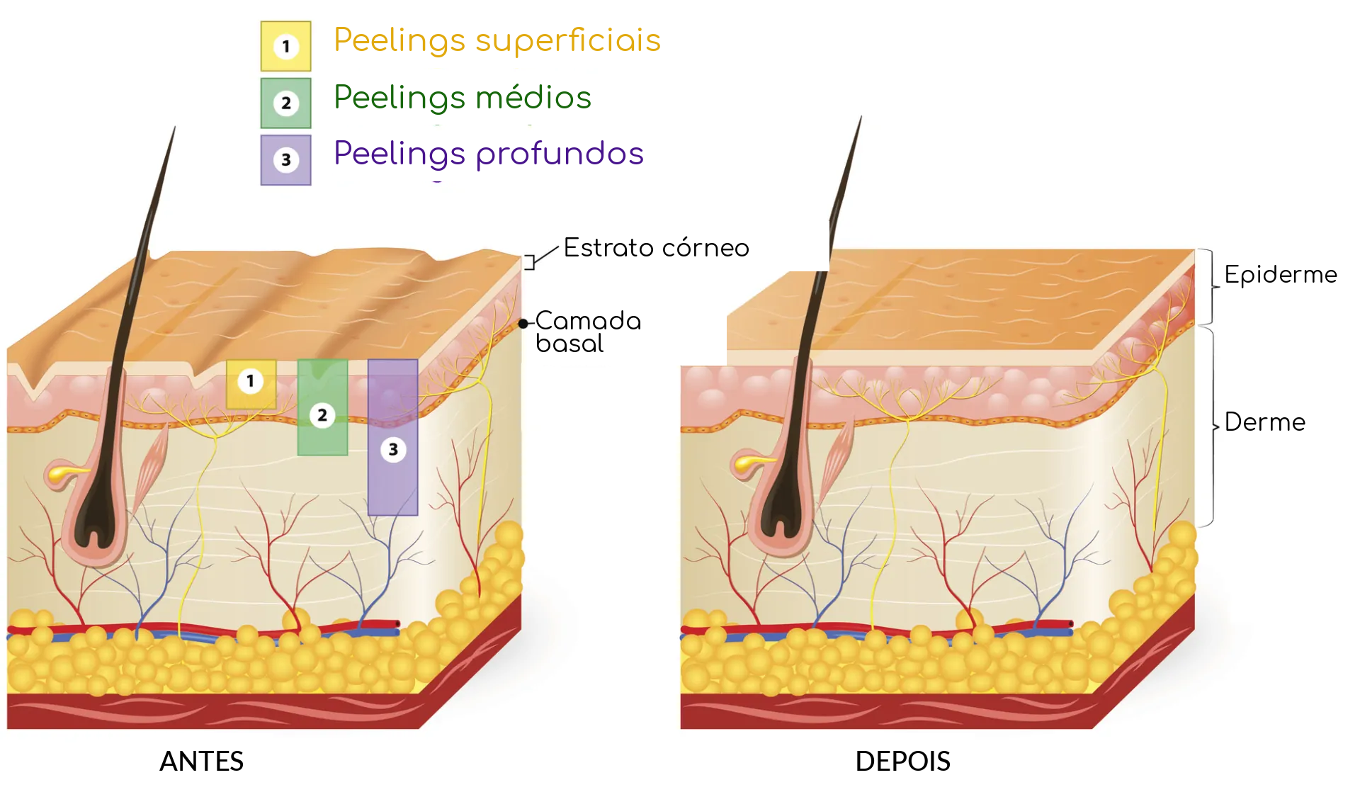 Tipos de peeling
