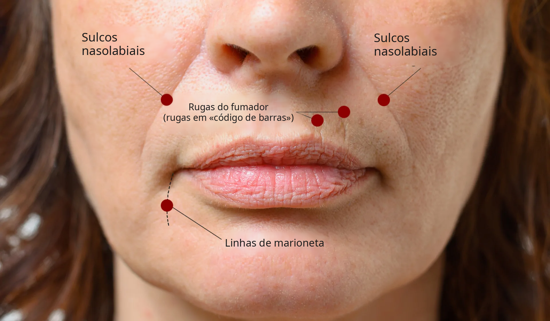 Rugas dos lábios