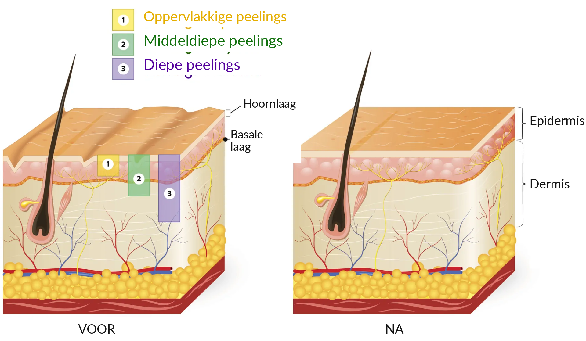 Soorten peelings