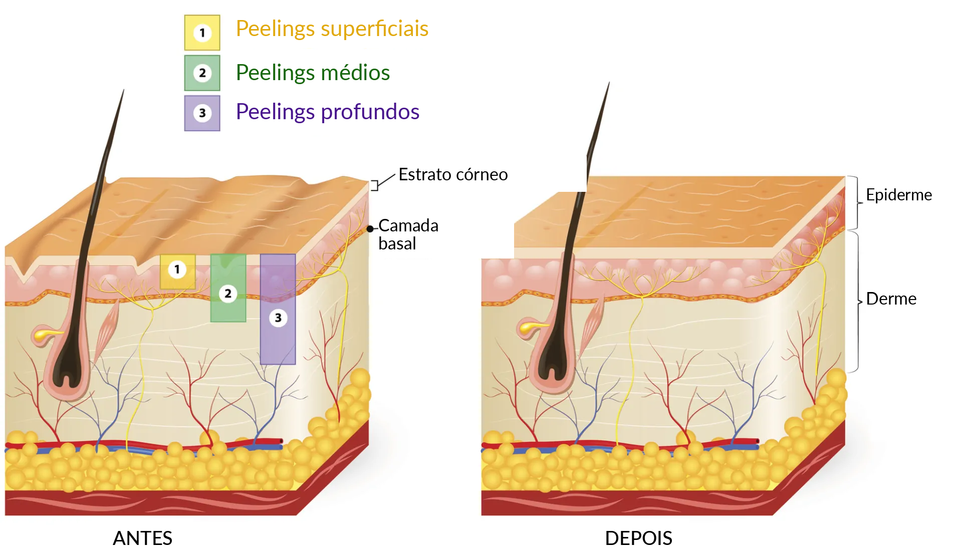 Tipos de peeling