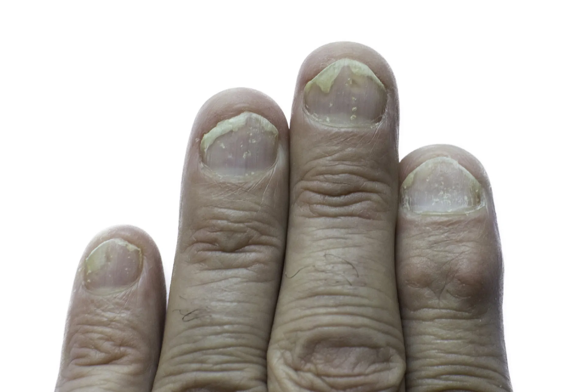 Psoriasi delle Unghie