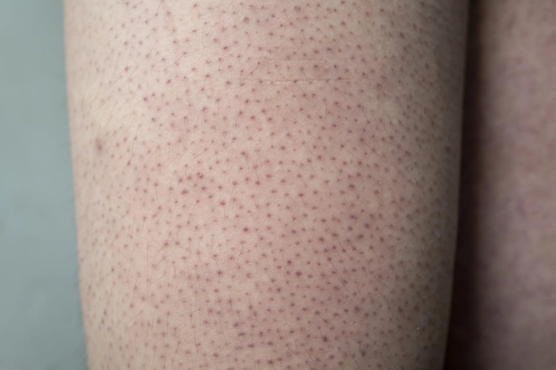 cheratosi pilare braccia