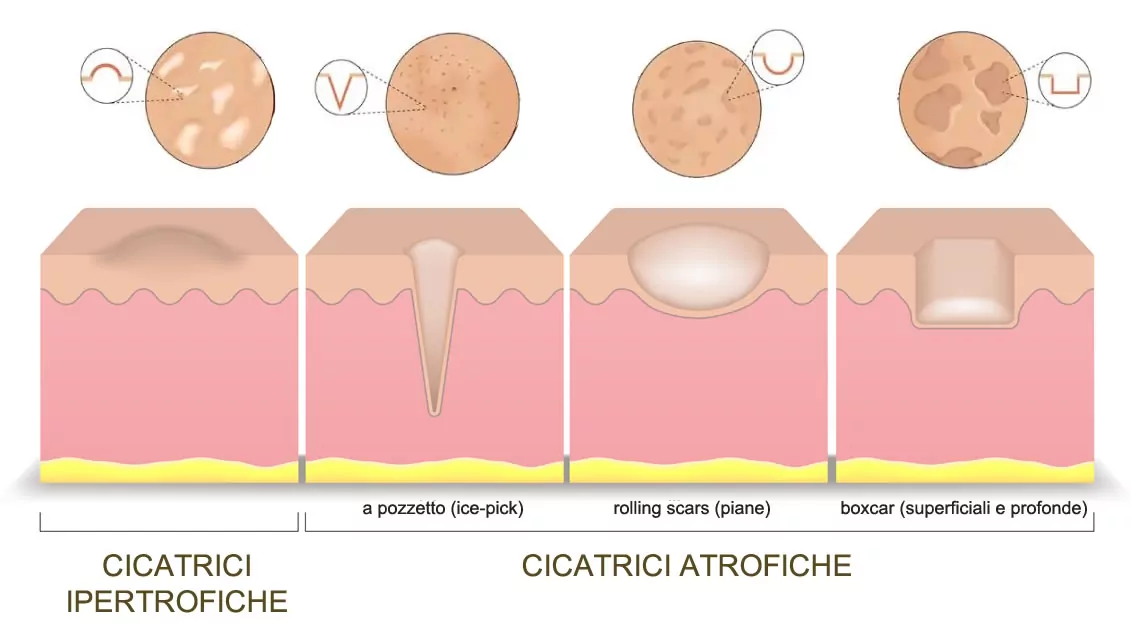 Tipi di Cicatrici Atrofiche Acne