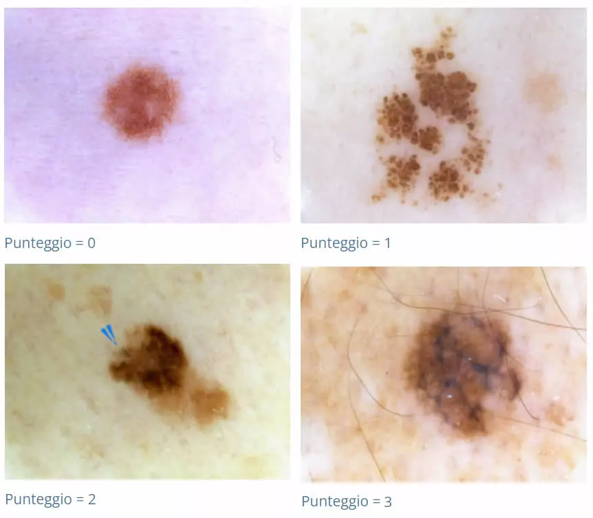 Melanoma Nevi Punteggi