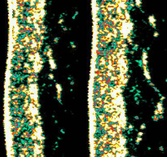 Collagene Botulino